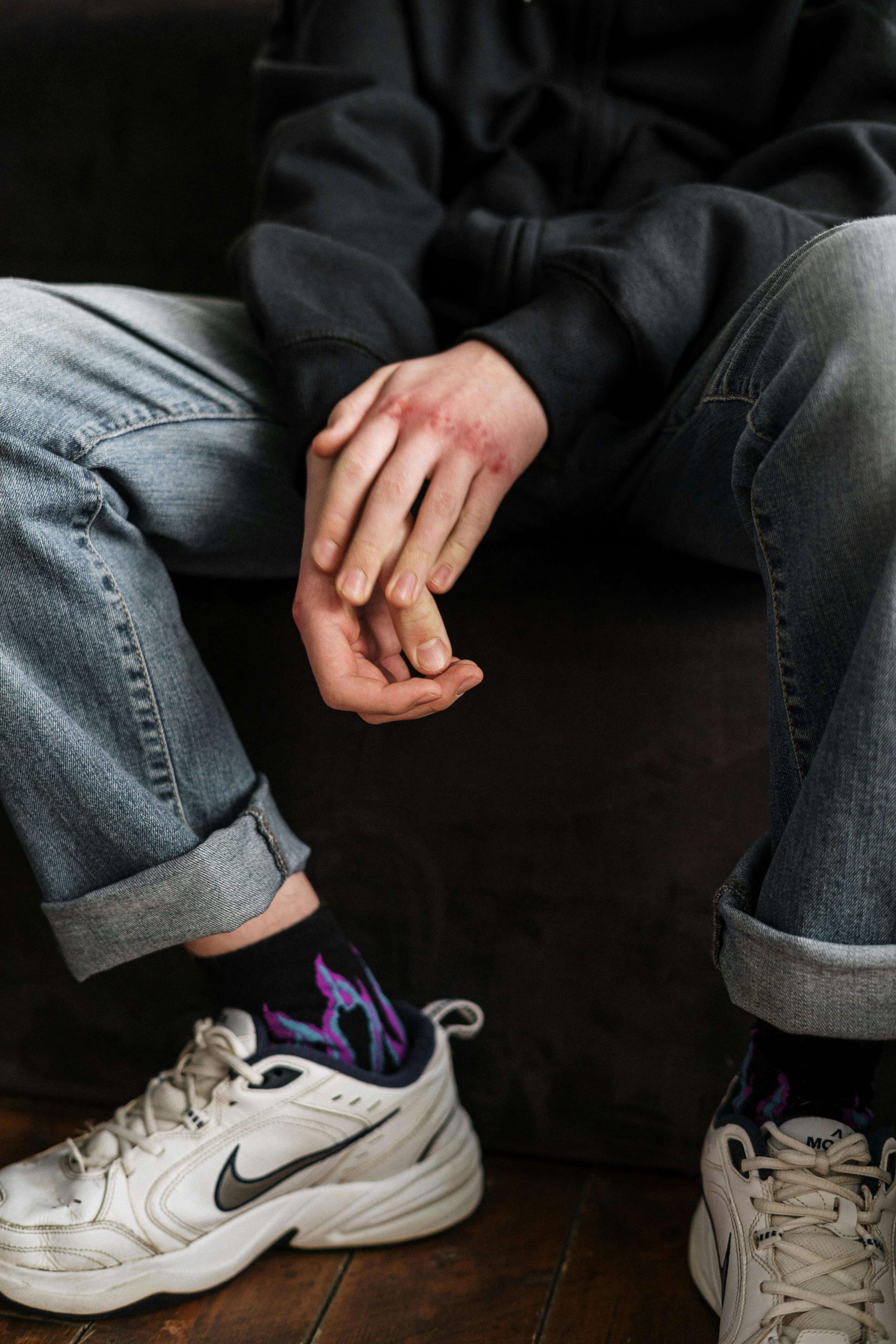 Close-up of a teen’s anxious, fidgeting hands marked with red scabs, a quiet but powerful image of the inner restlessness that ADHD medication management in Tempe, AZ, can help soothe.